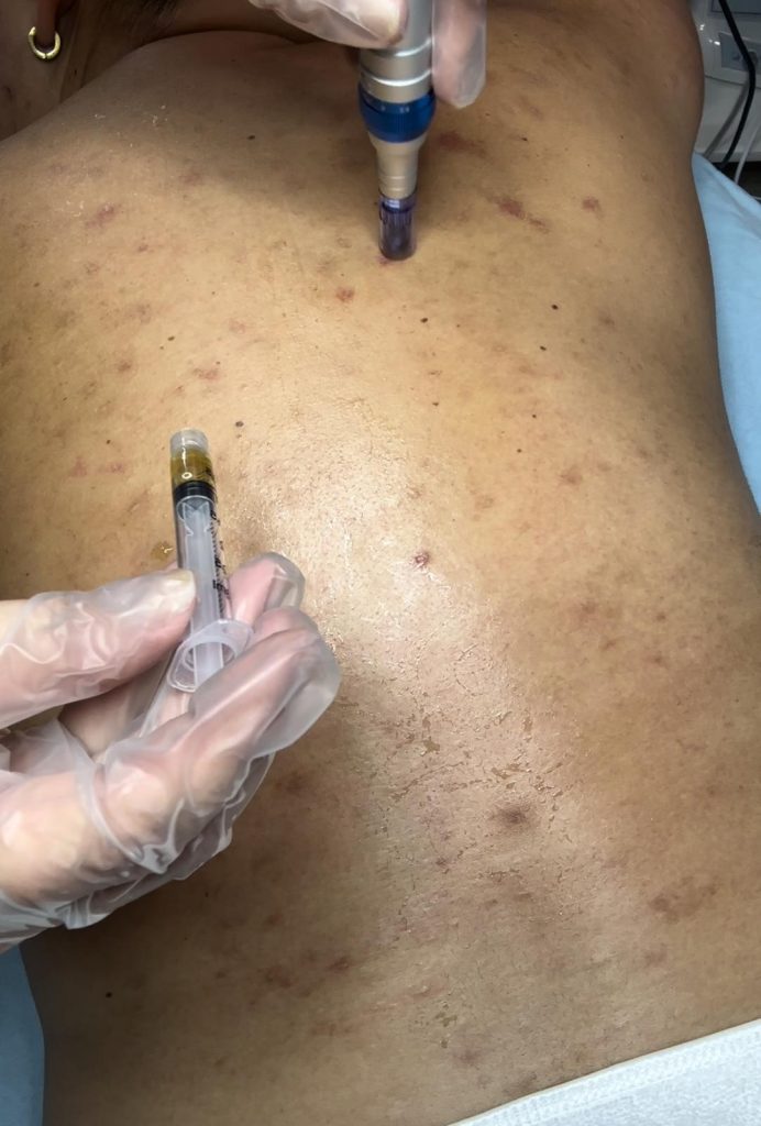 Acne Scar