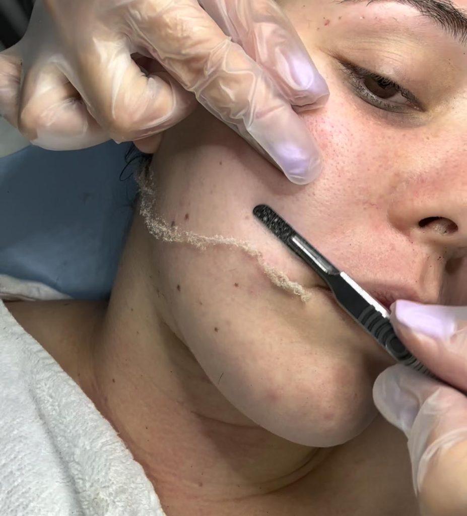 Dermaplaning