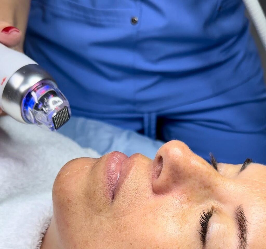 Fractional Radiofrequency