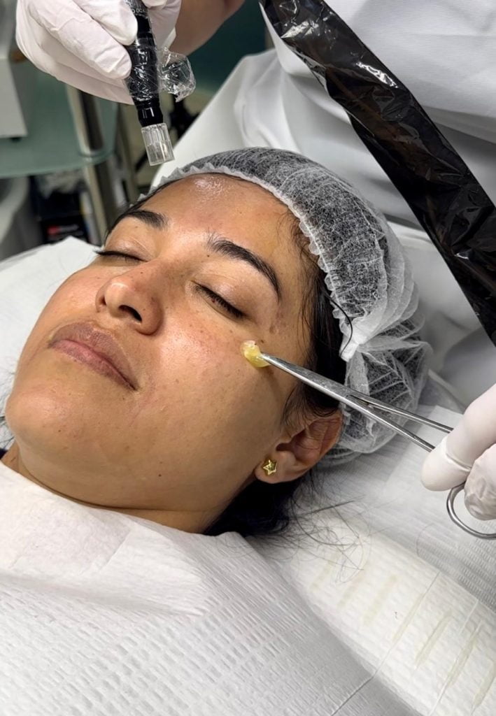 Regenerating PRF & Dermapen